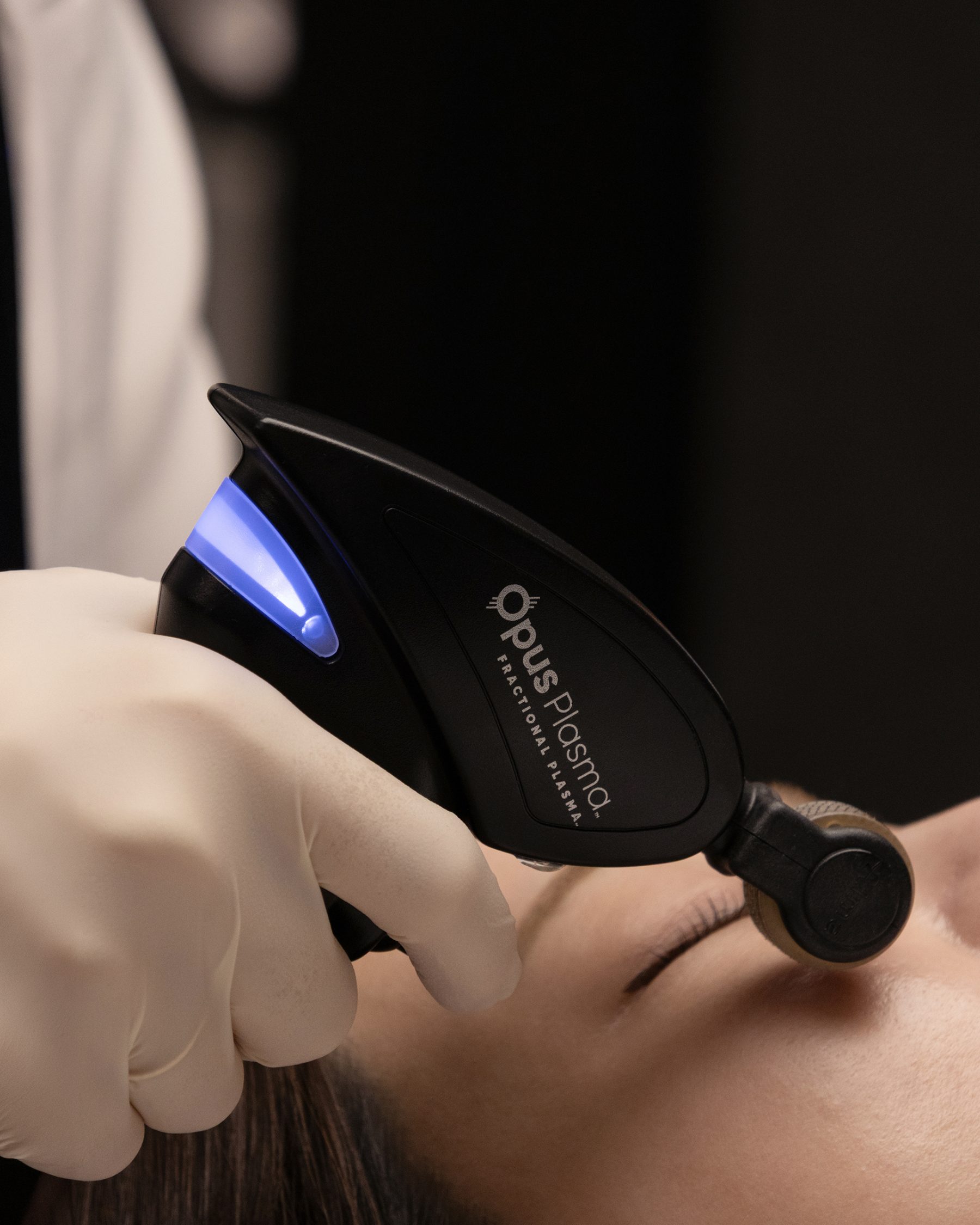Fractional plasma device treatment in the clinic