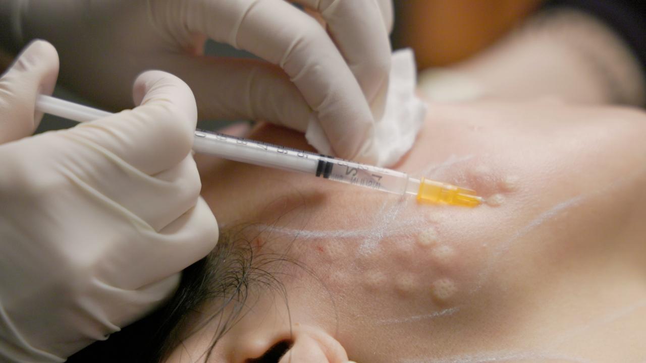 Intradermal injection into post-procedure skin